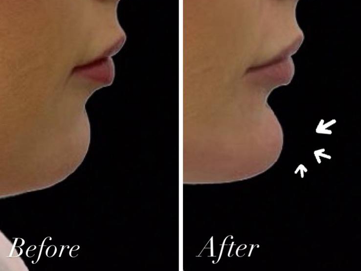 Chin enhancment service