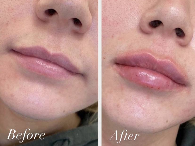 lips augmentation service