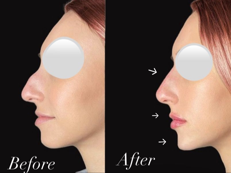 Nose remodelation service